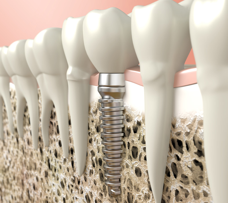 Image illiustration of dental implants in Richmond Hill