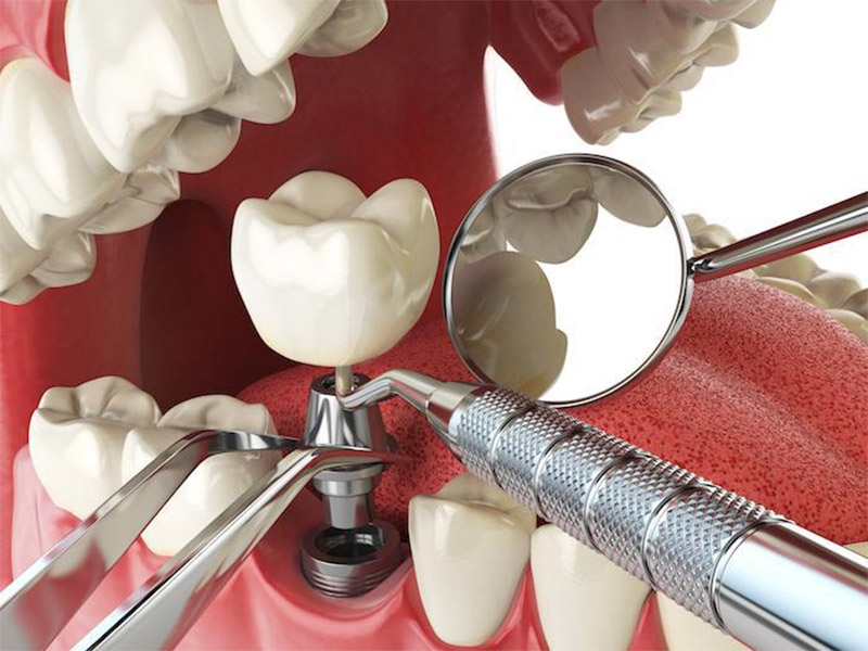Image illiustration of dental implants at your nearest dental clinic
