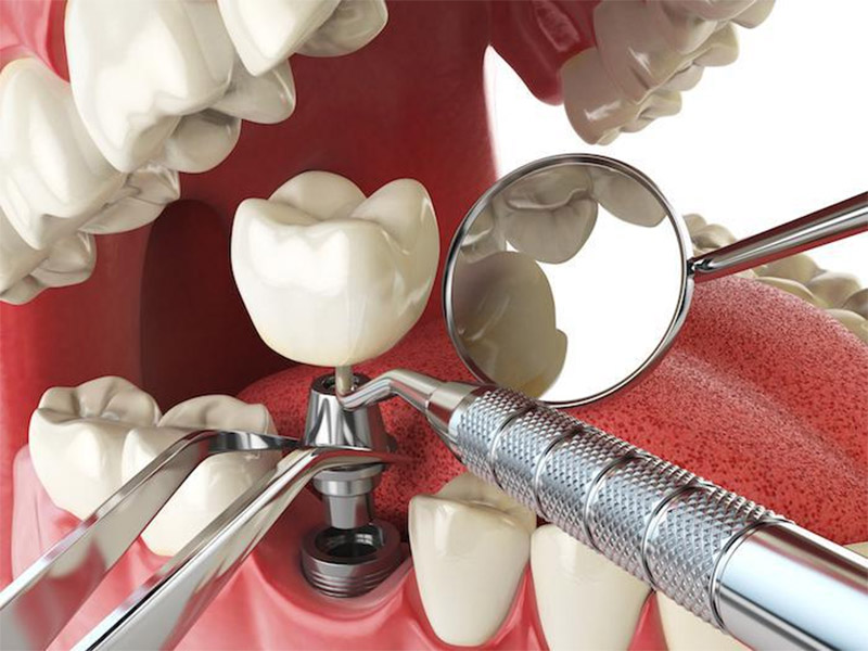 Dental Implants Near You