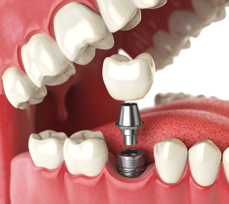 Image illiustration of dental implants in Richmond Hill