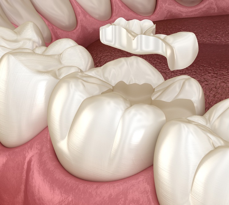 Illustration of inlays onlays in nearet dental clinic