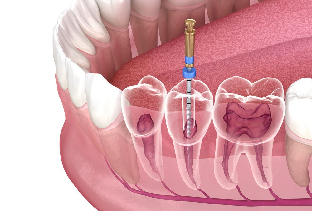 everything you need to know about root canal