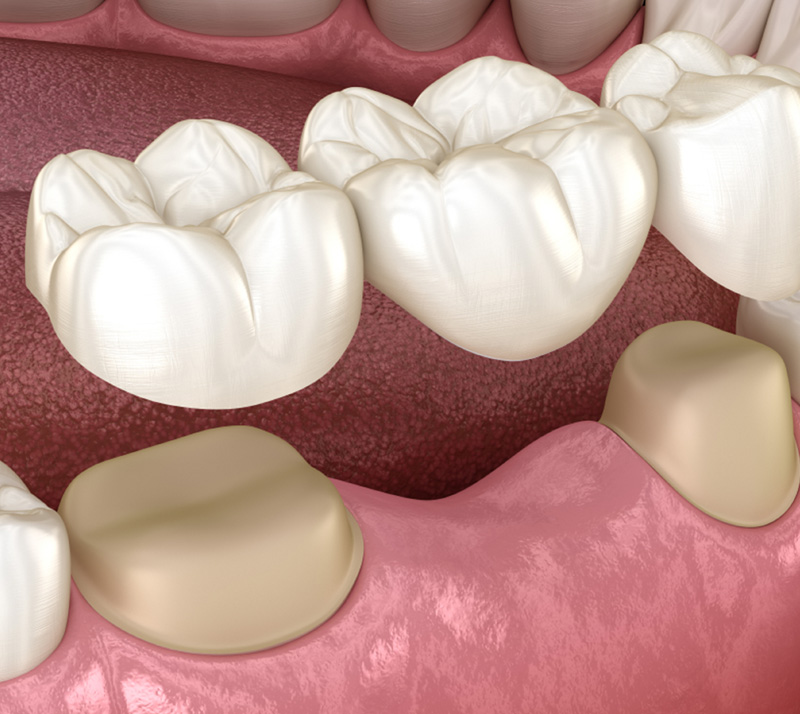 Image illustration of dental bridges at your nearest dental office