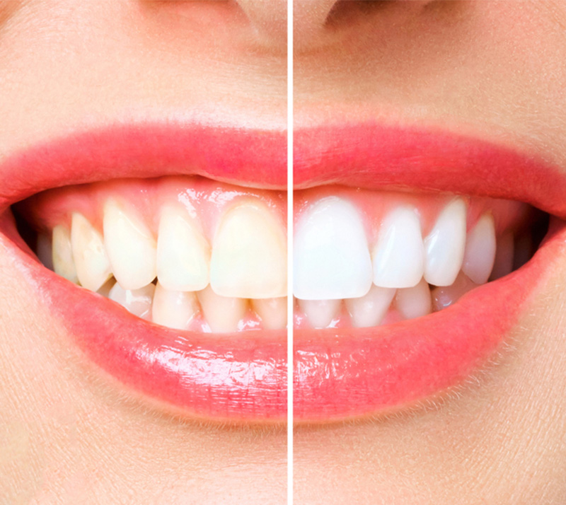 Before after results of teeth whitening near you at Carrville Family Dentistry