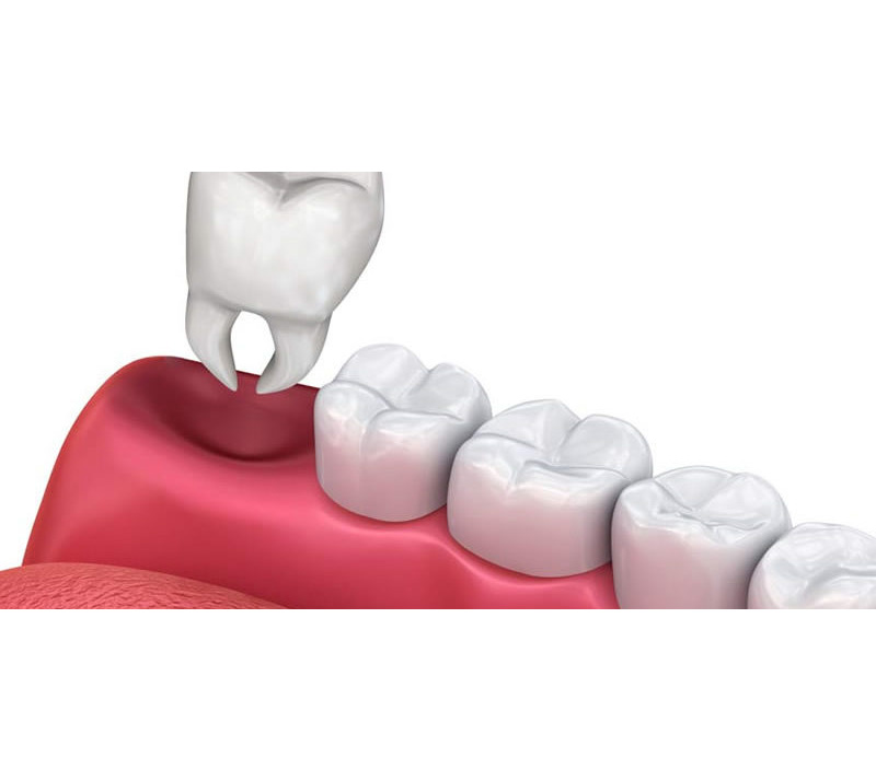 Image illustration of tooth extractions in Richmond Hill