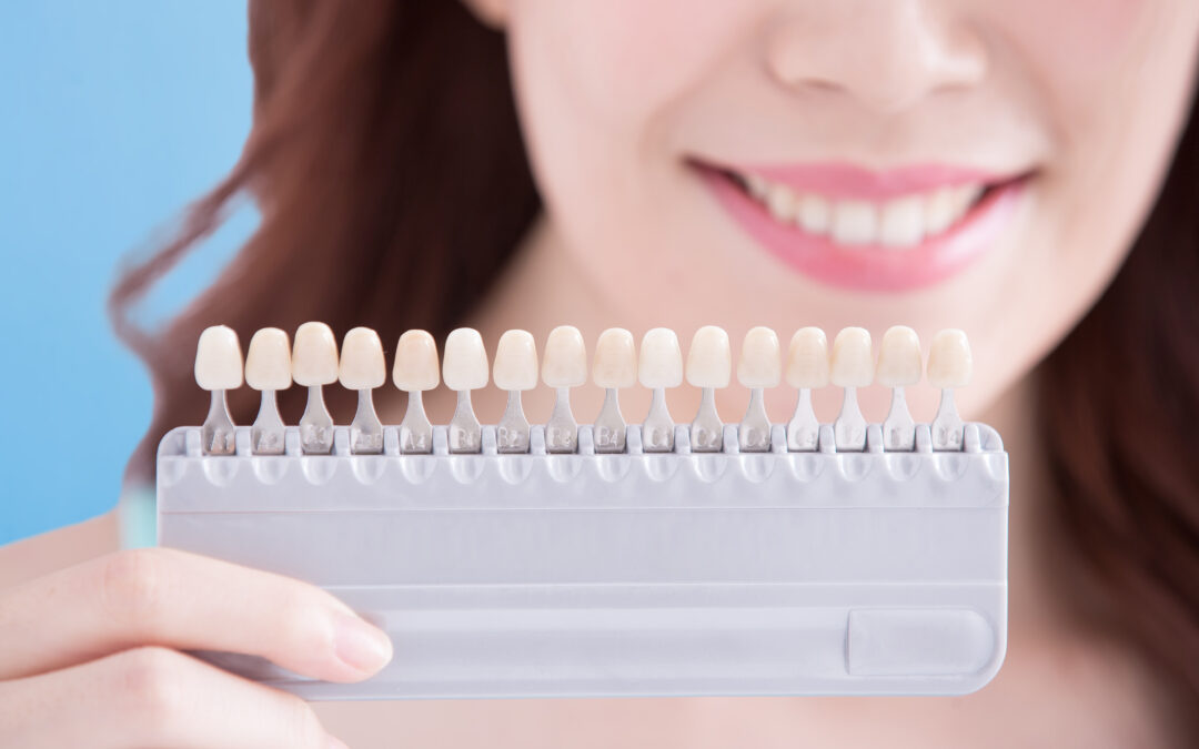 Six Advantages of Veneers to Get Those Pearly Straight Teeth